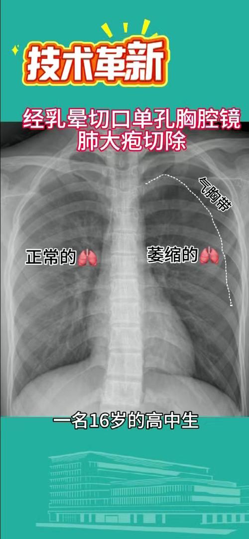 因气胸缺席至今！活塞官方：坎宁安正在康复将在一周后接受复查